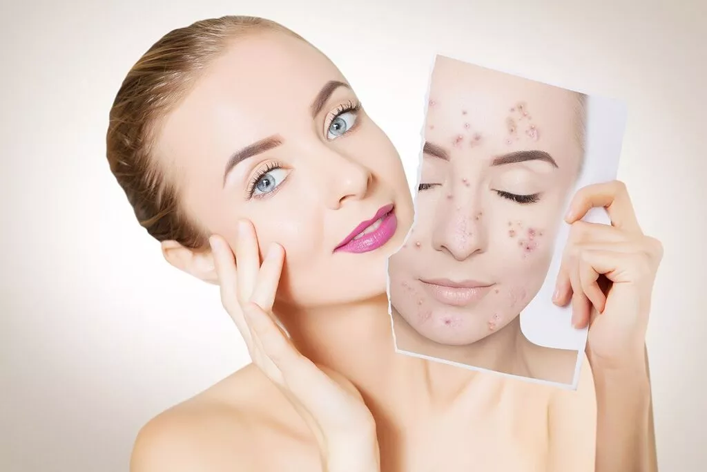 Acne scar treatment in delhi