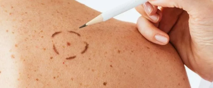 birthmark removal​