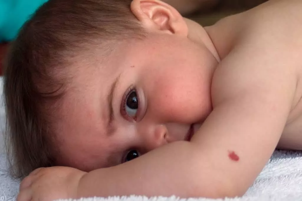 birthmark removal​