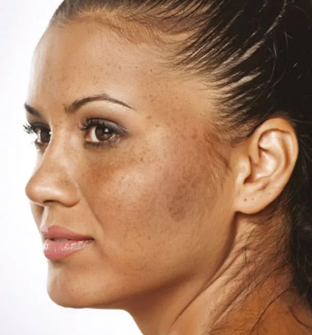 best treatment for melasma on face​