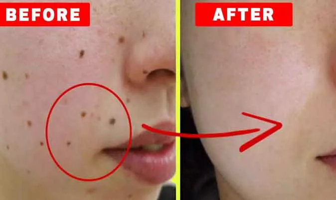 mole removal near me​ laser mole removal