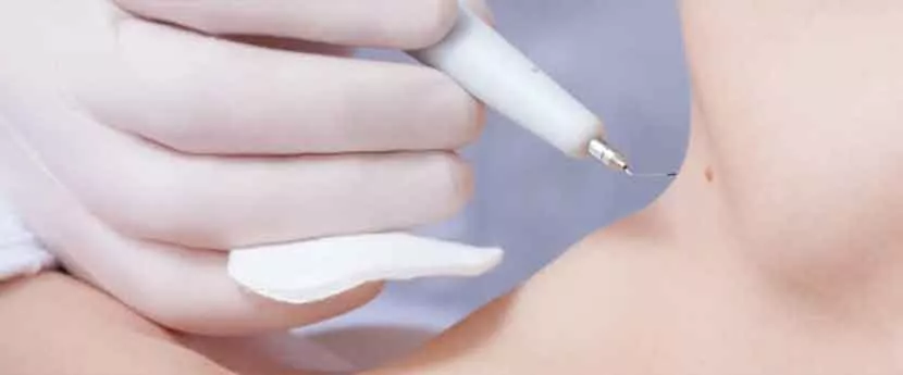 mole removal near me​ laser mole removal