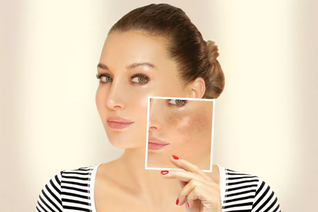 skin whitening treatment