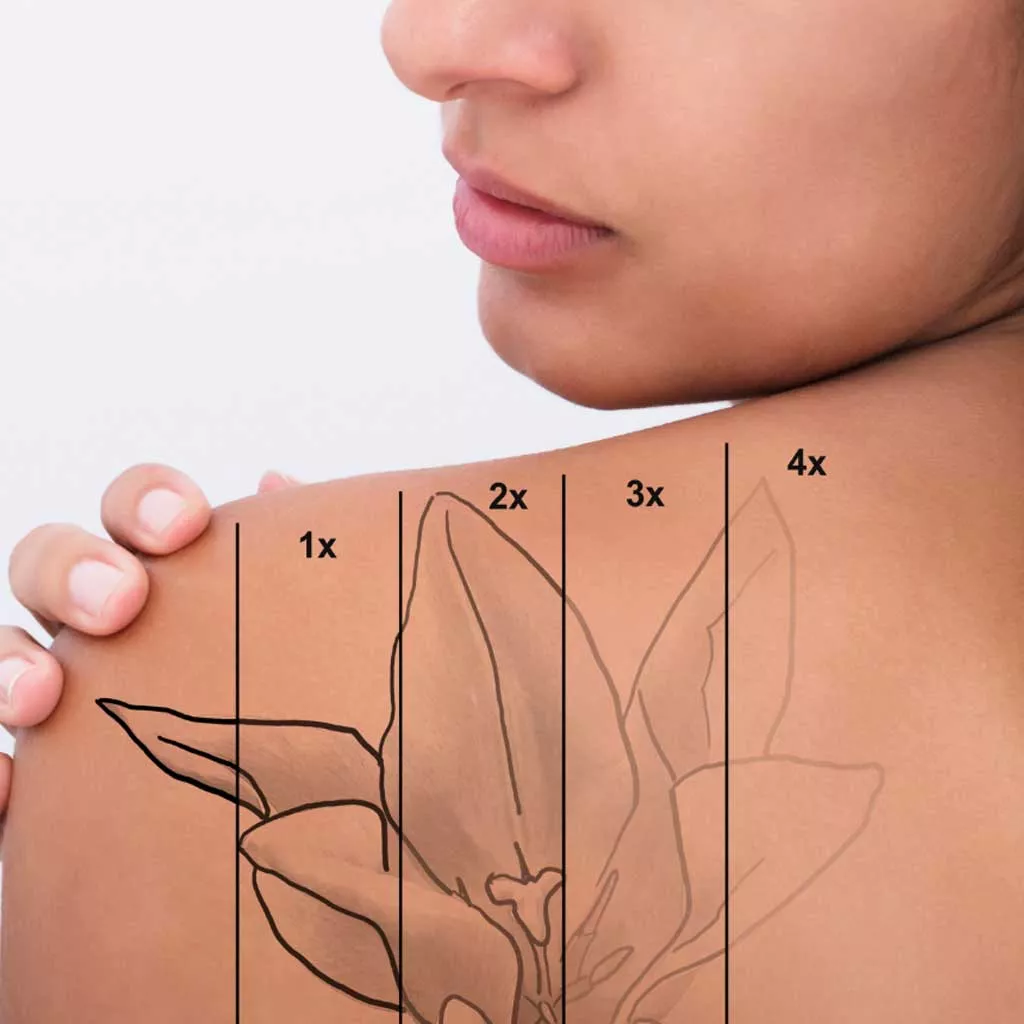 tattoo removal near me