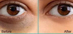 Under Eye Dark Circles Treatments7
