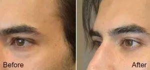 Under Eye Dark Circles Treatments8