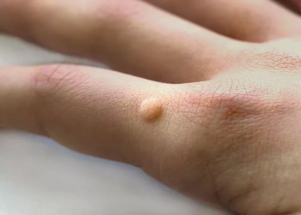 wart removal near me