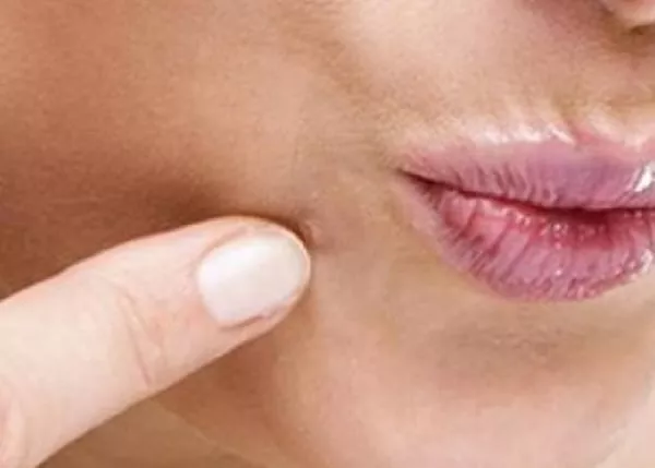 wart removal near me