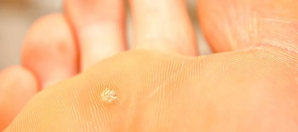 wart removal near me