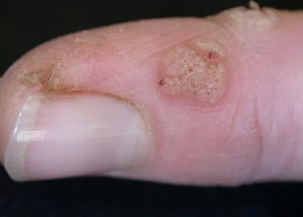 wart removal near me