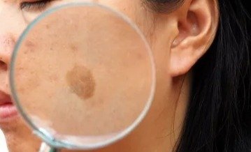 best treatment for melasma on face​