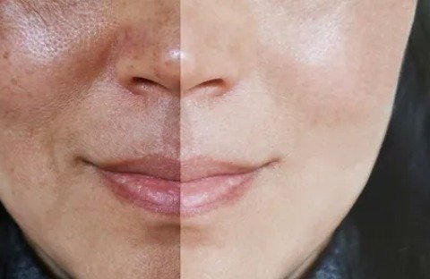 best treatment for melasma on face​