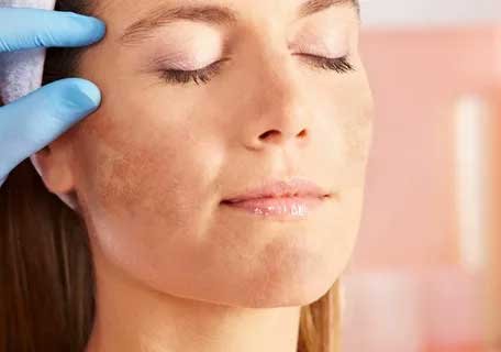 best treatment for melasma on face​
