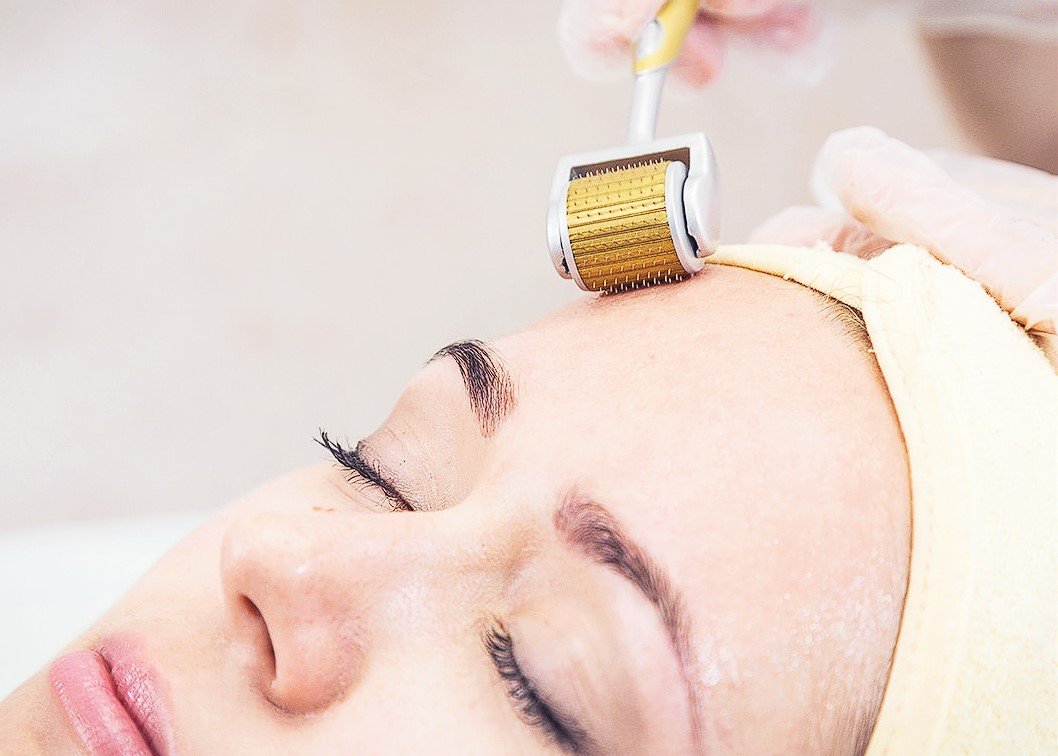 laser treatment for stretch marks